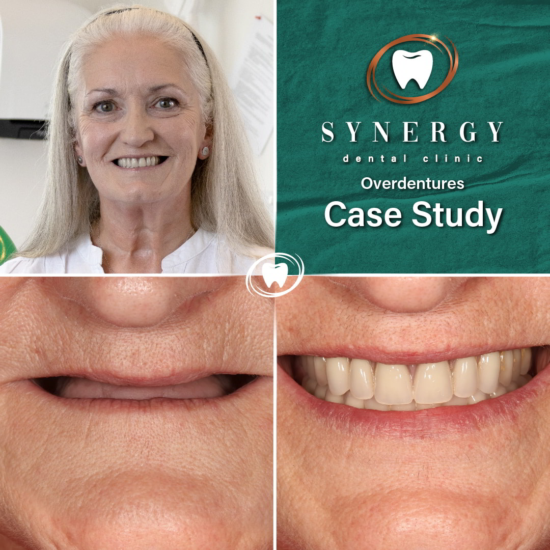 Dr. Zuber Bagasi Synergy Blackpool Implant Overdentures • Synergy(03)