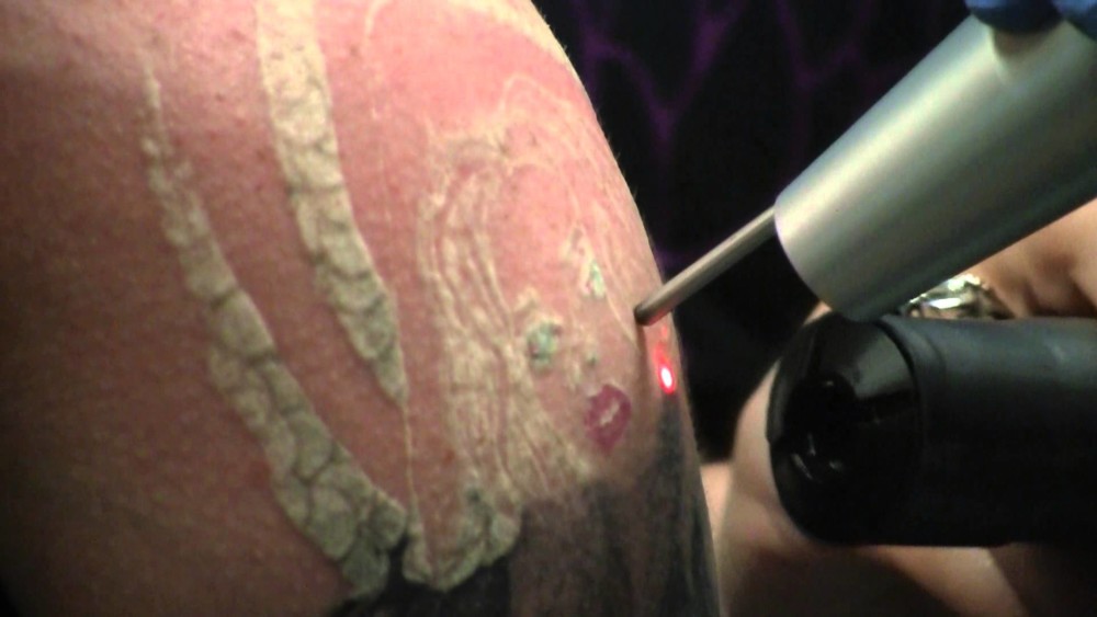 Is It Worth Undergoing A Laser Tattoo Removal Procedure? – Times Square Chronicles 563_x_1000_jpg