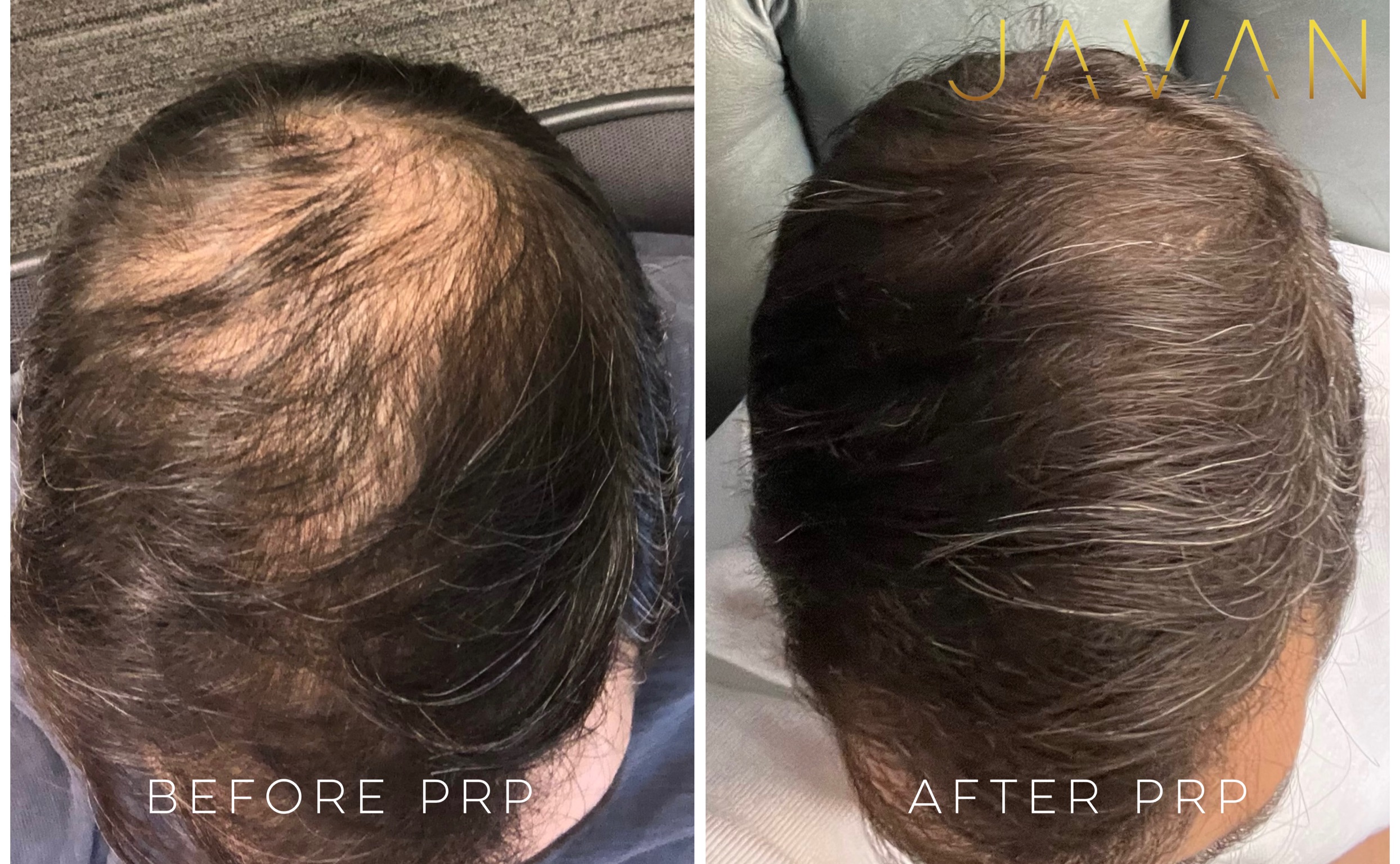 Hair Loss Treatments Javan AntiAging and Wellness Institute