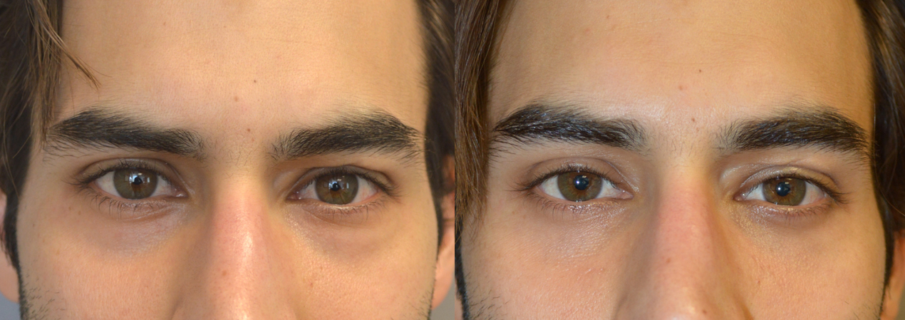  Taban MD oculoplastic cosmetic eyelid plastic surgeon Beverly Hills