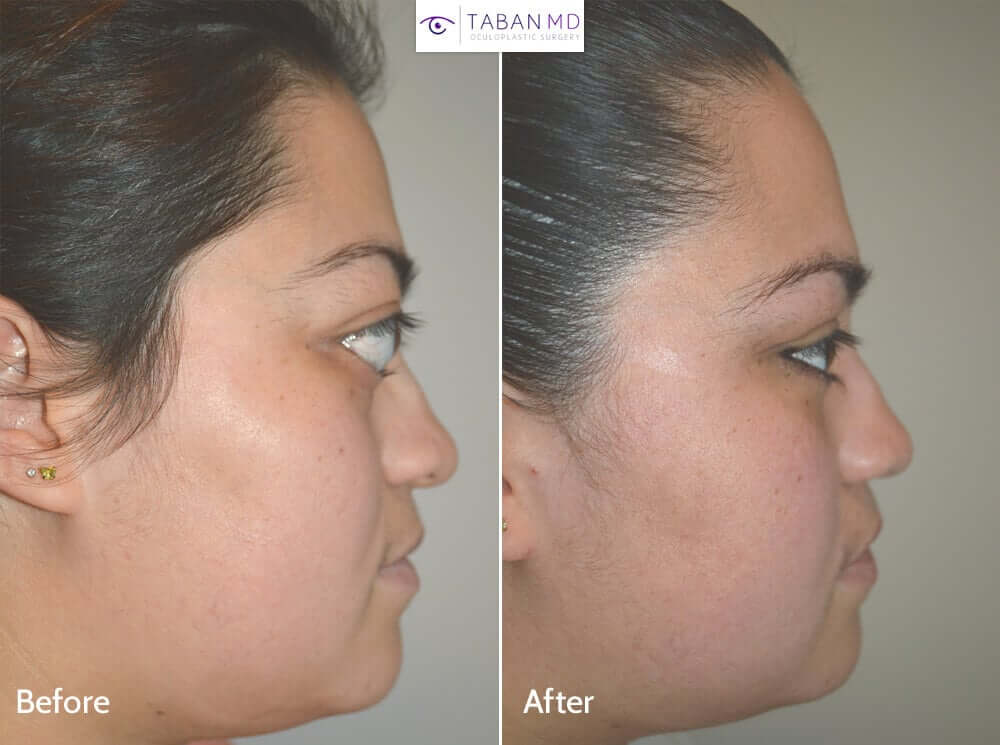 Orbital ( Bulging Eye ) Gallery Before and After Photos