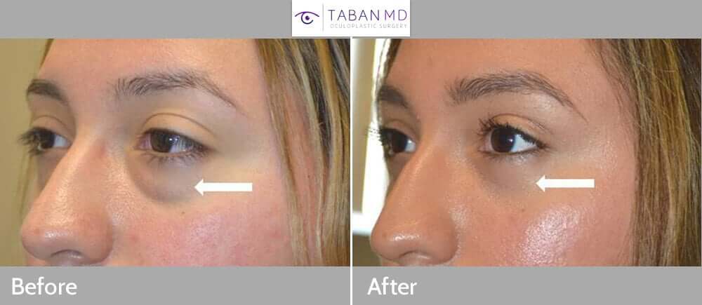 Before and After Lower Blepharoplasty Photo Gallery Taban MD