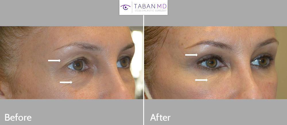Upper Blepharoplasty Before and After Gallery Taban MD
