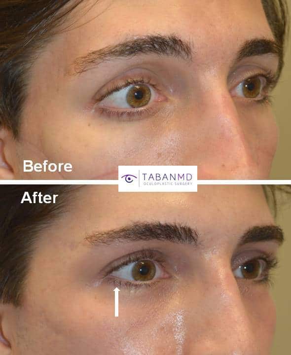 Eyelid Retraction Surgery Before and After Photos Taban MD