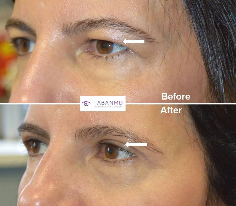 Cool Los Angeles Eyelid Surgery References