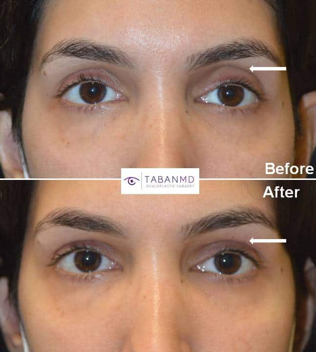 Almond Eye Surgery Before and After Gallery Taban MD