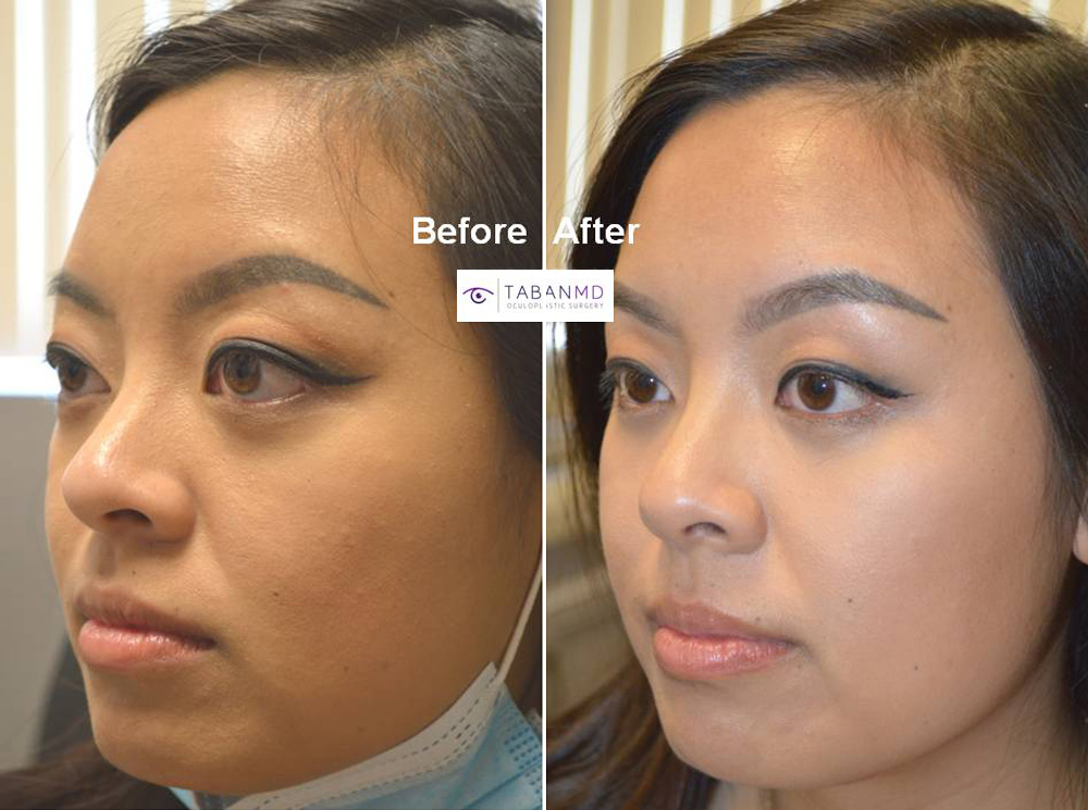 Orbital ( Bulging Eye ) Gallery Before and After Photos
