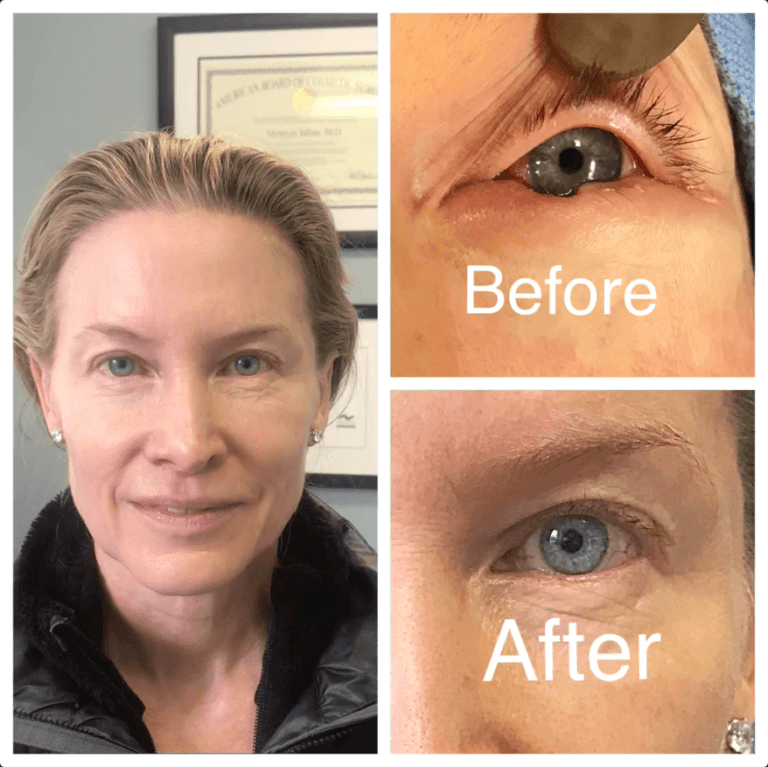 Selecting a Beverly Hills Oculoplastic Surgeon Taban MD