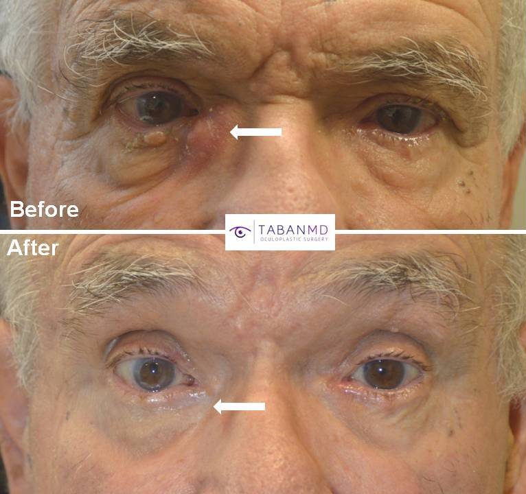 Lacrimal Tear Duct Eye Surgery Specialists Beverly Hills CA