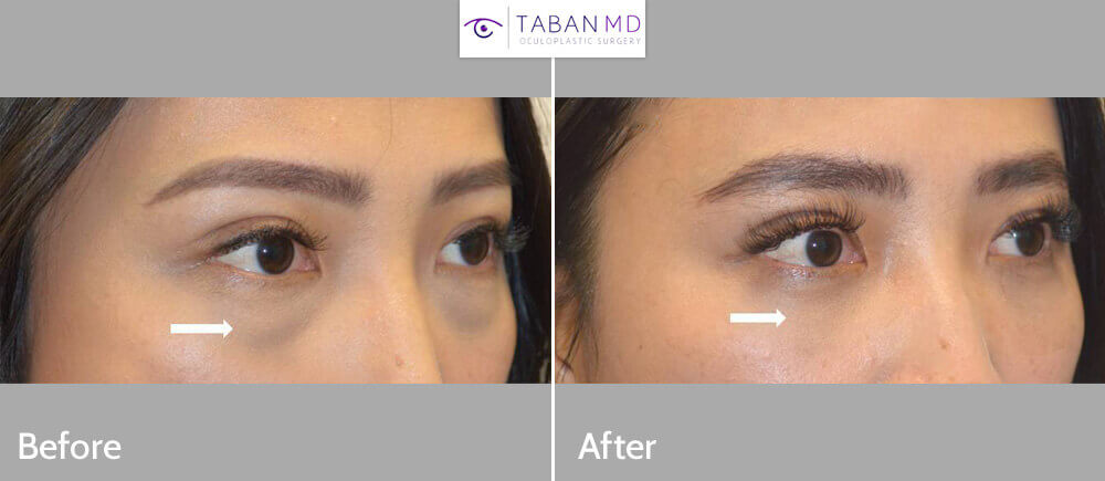 Before and After Lower Blepharoplasty Photo Gallery Taban MD