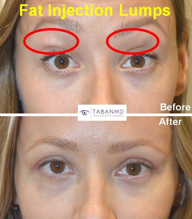 Eyelid Revision Surgery Beverly Hills Revision Blepharoplasty