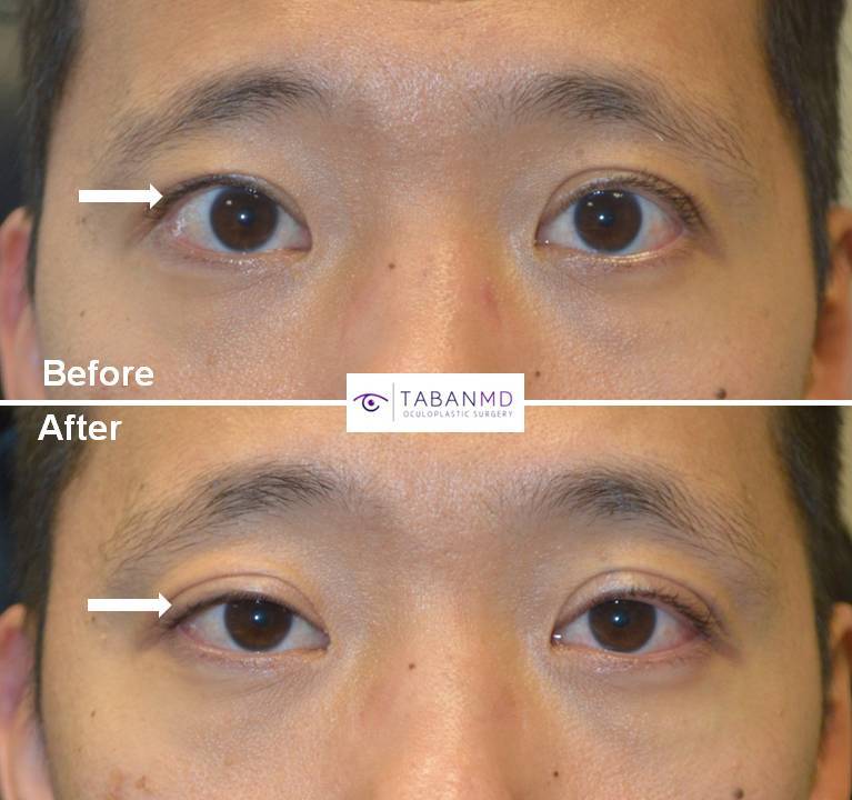 Beverly Hills Eyelid Retraction Graves Disease Treatment