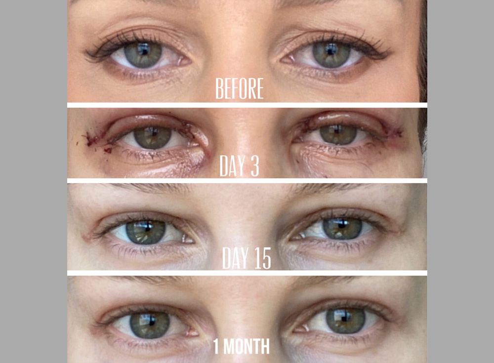 Upper Blepharoplasty Beverly Hills Eyelid Lift Los Angeles