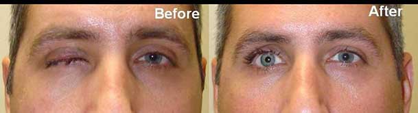 Eyelid Enucleation Evisceration Surgery Experts Los Angeles
