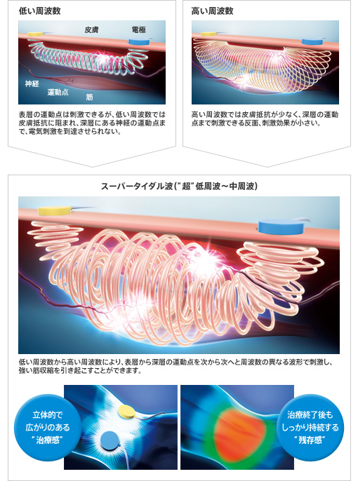 干渉波 治療機械の紹介 たち接骨院