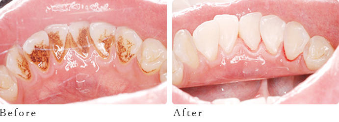 たばこによる歯の汚れ・口臭予防・クリーニングについて.新宿のタカベデンタルクリニック