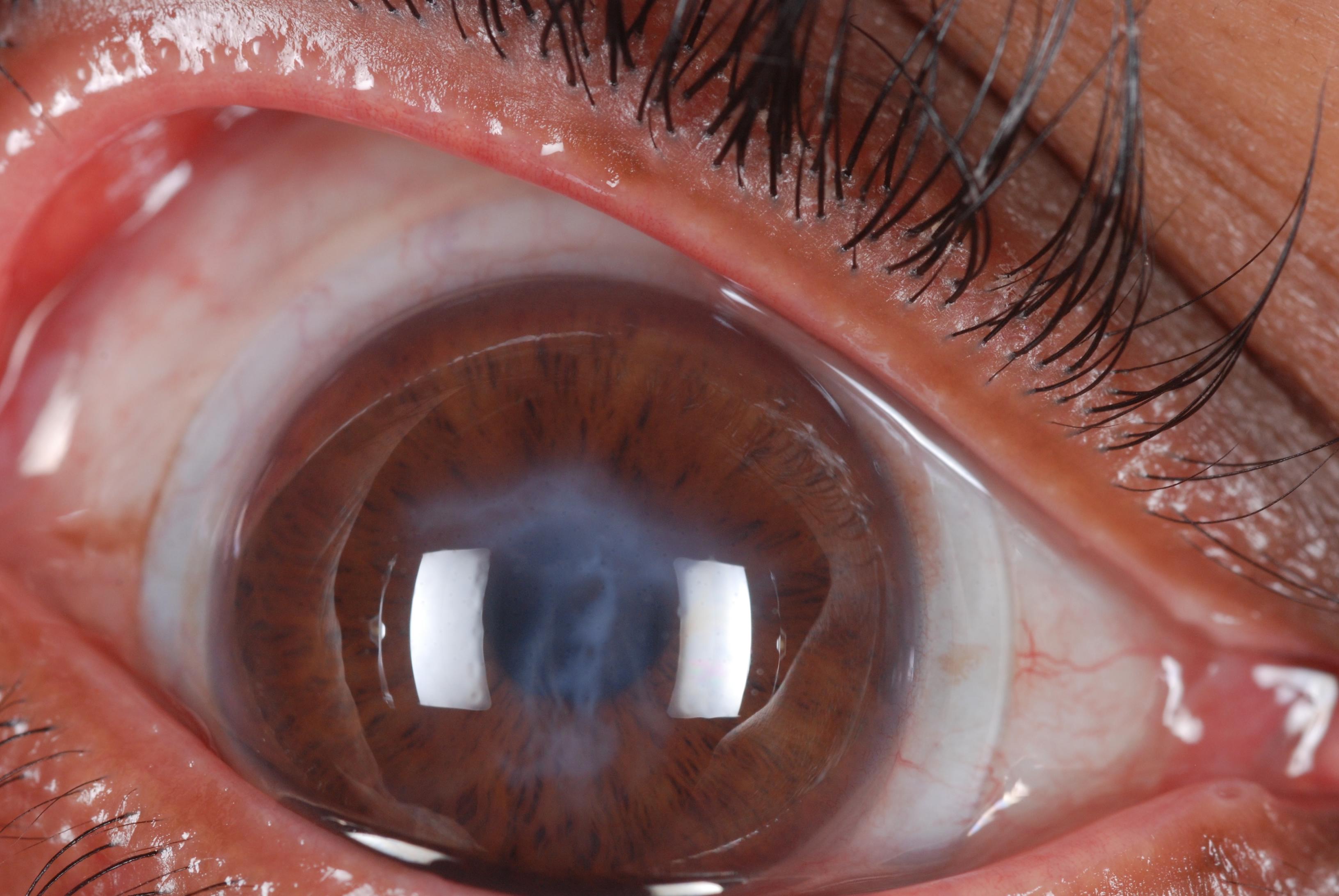 Cataract Surgery in the Keratoconic Patient Tal Raviv, MD, FACS