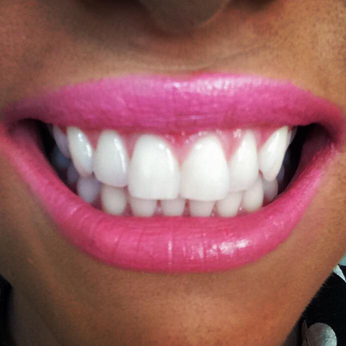 Brand new pearly whites Tantastic Tantastic