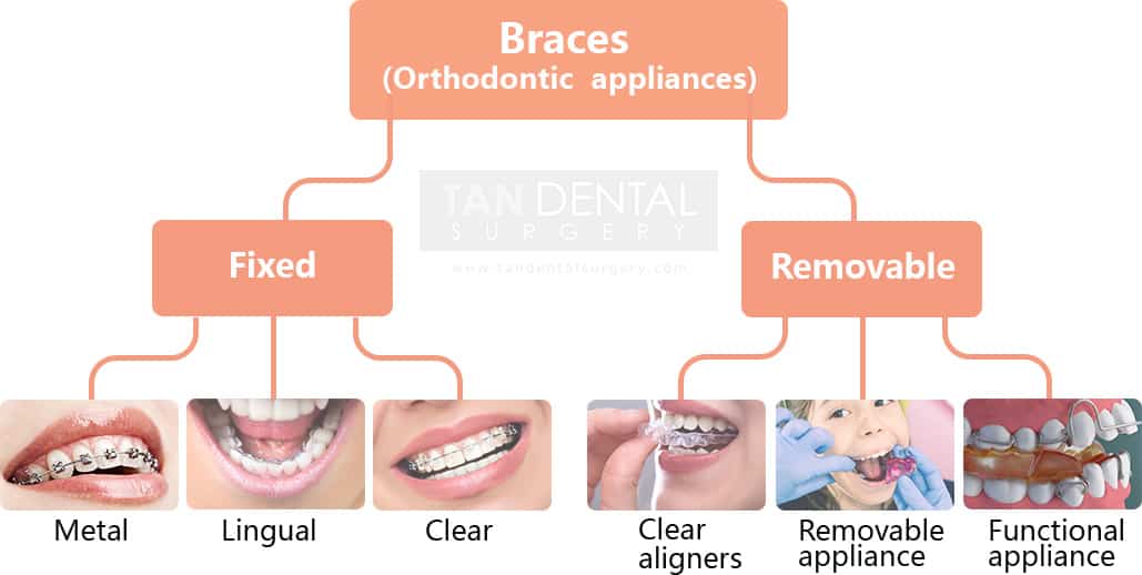 Braces cost in Malaysia Top 5 things to know Tan Dental Surgery