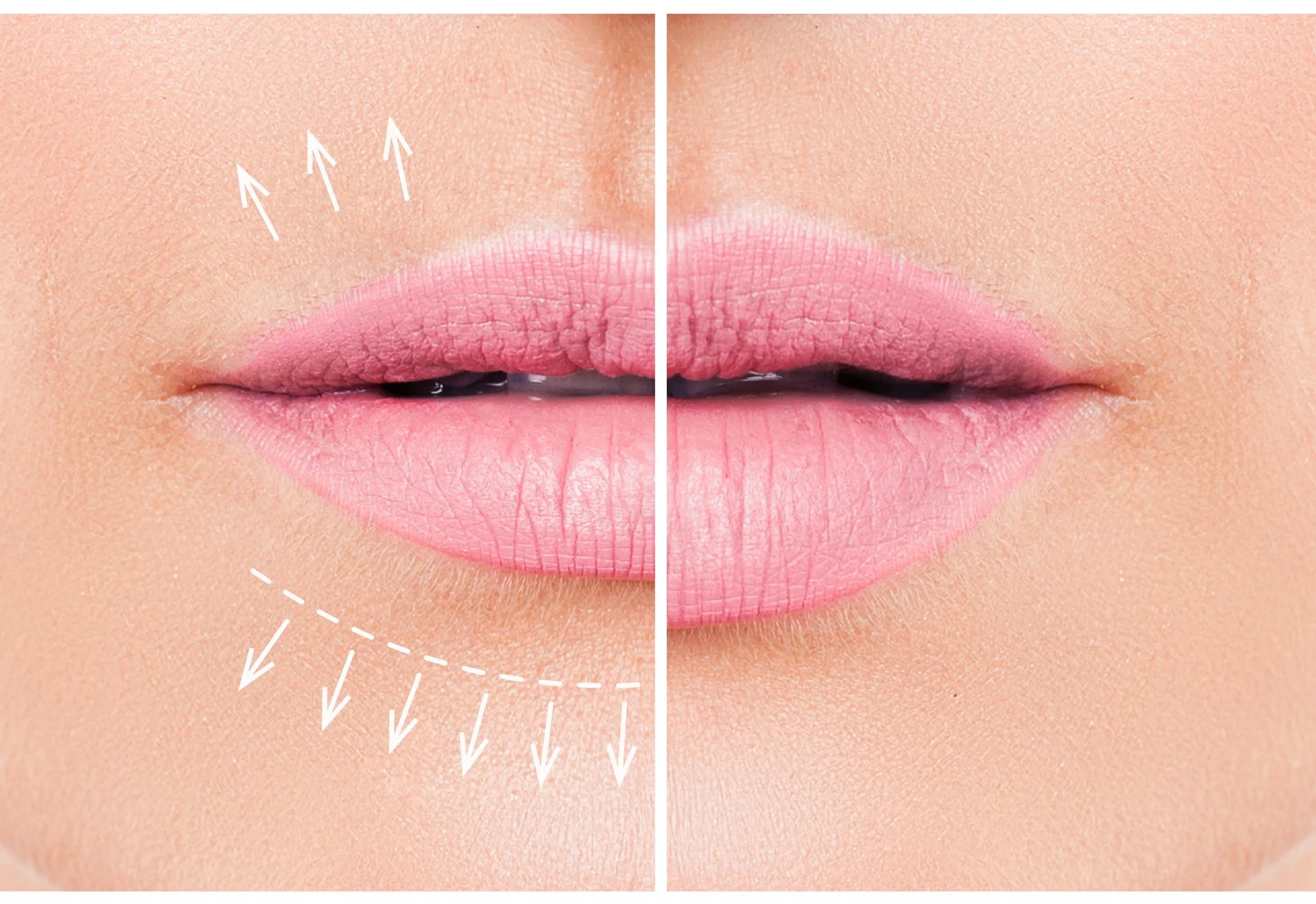 Lip Fillers vs Fotona Liplase what’s the difference? Dr Tanja