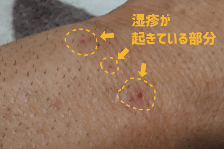 男だけど腕毛を脱毛したい！ムダ毛のせいでかゆくなるので毎日剃ってるがひたすら面倒・・・