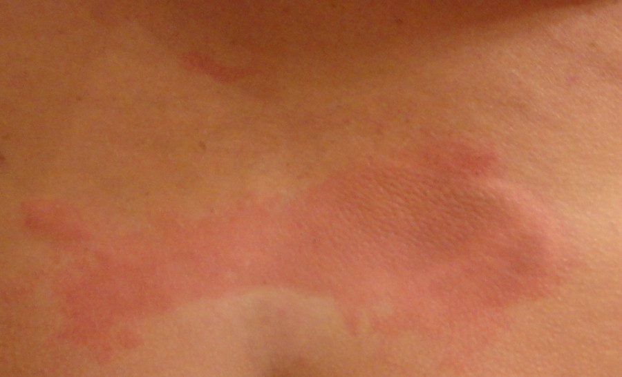 Frostbite rash Maple suyrup diet