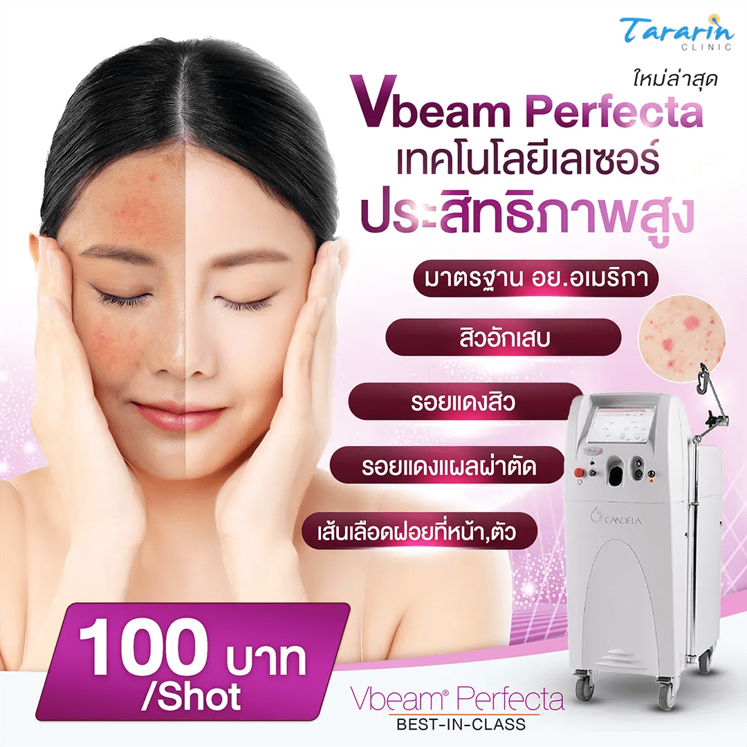 รู้จัก Vbeam Laser รุ่น Perfecta ท็อปใหม่ล่าสุด เทคโนโลยีที่รักษารอยโรค