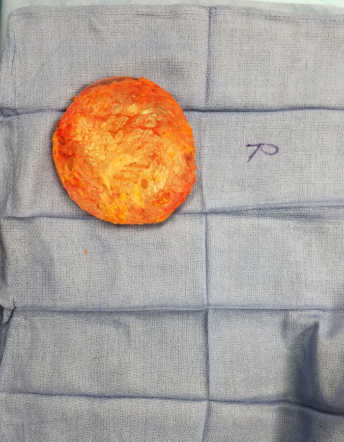 Breast Implant Removal Doctors Breast Implant Removal & Lift Nashville