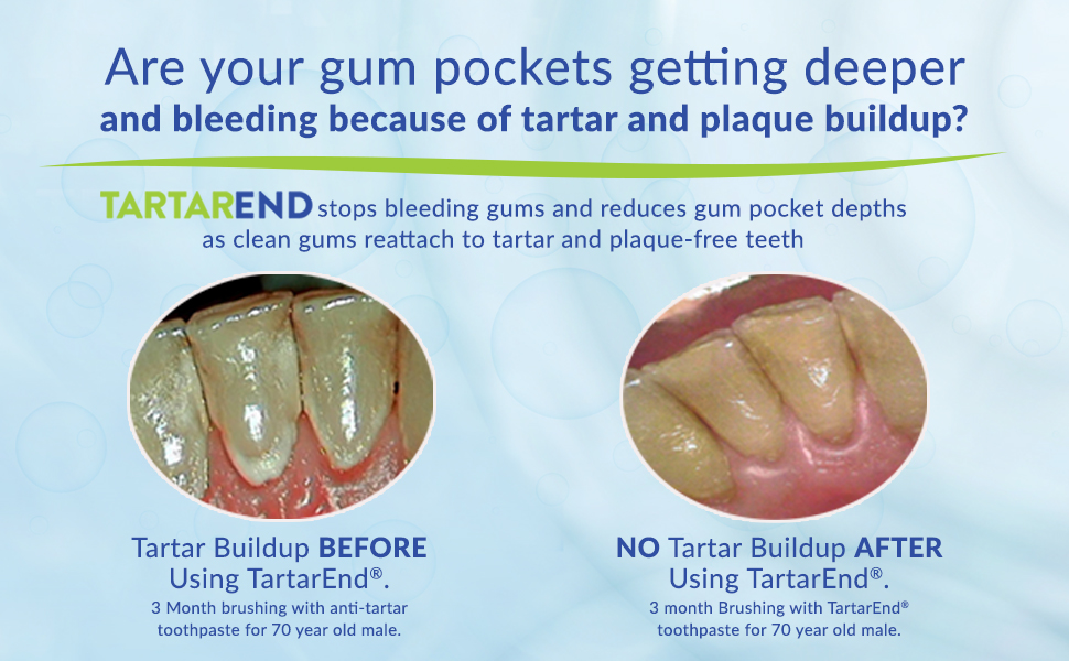 Remove Tartar, Plaque & Dental Calculus TartarEnd® Toothpaste