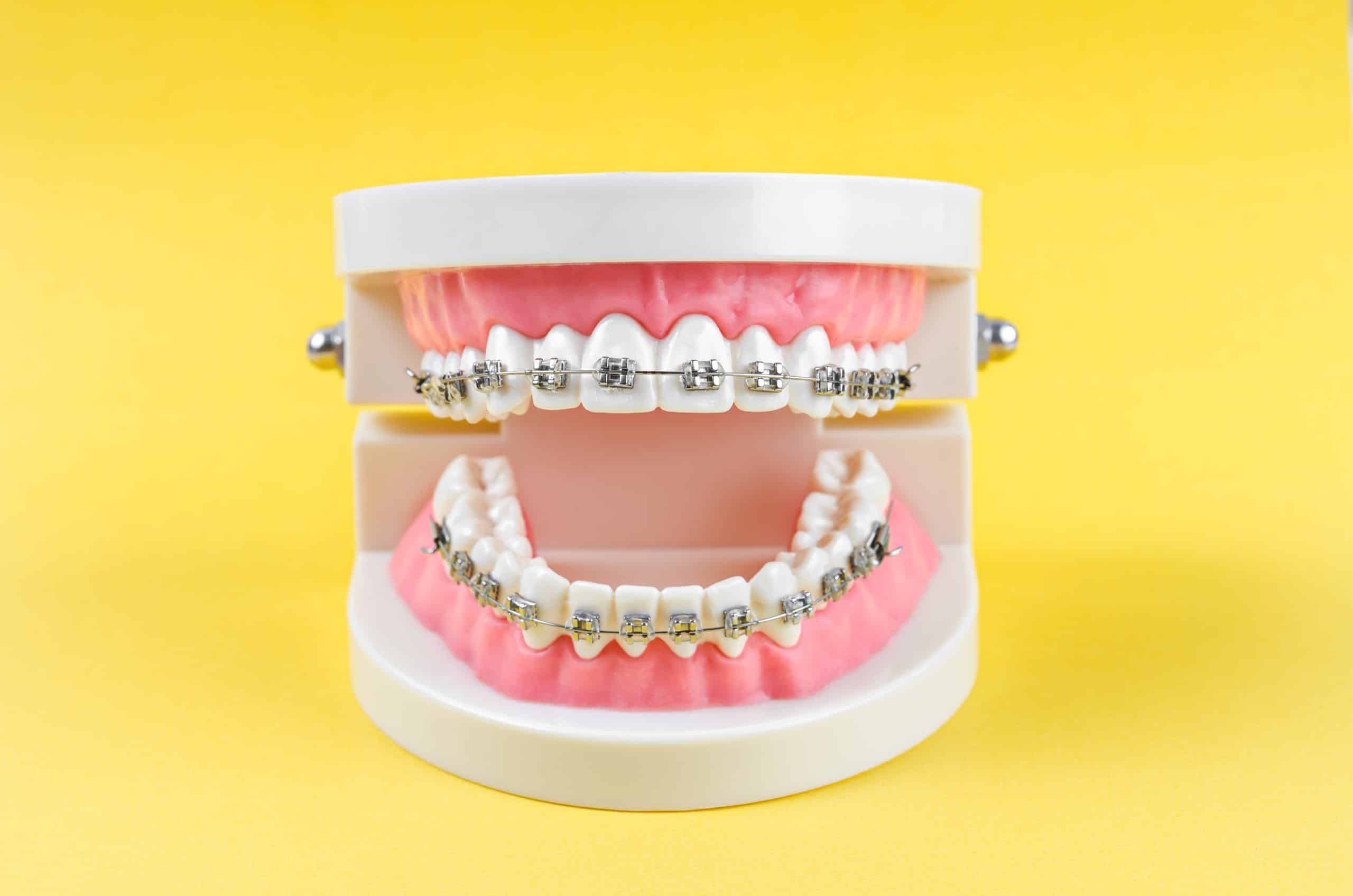 What is the Right Time to Get Braces?