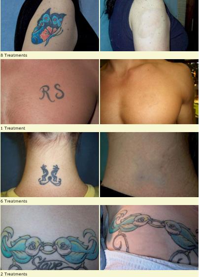 Tattoo Undo – Tattoo Removal And Tattoo Cover Ups For Weddings | Regret Your Tattoo? 562_x_404_jpg