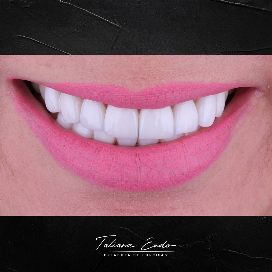 TEETH WHITENING Odontologia en Cali