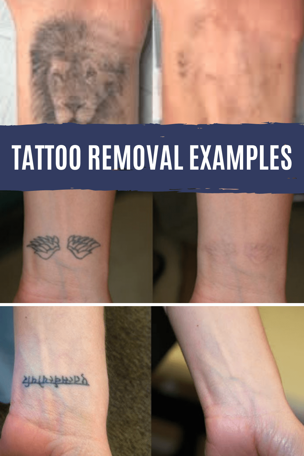 Top 3 Tattoo Removal Procedures That You Can Use Tattoo Glee