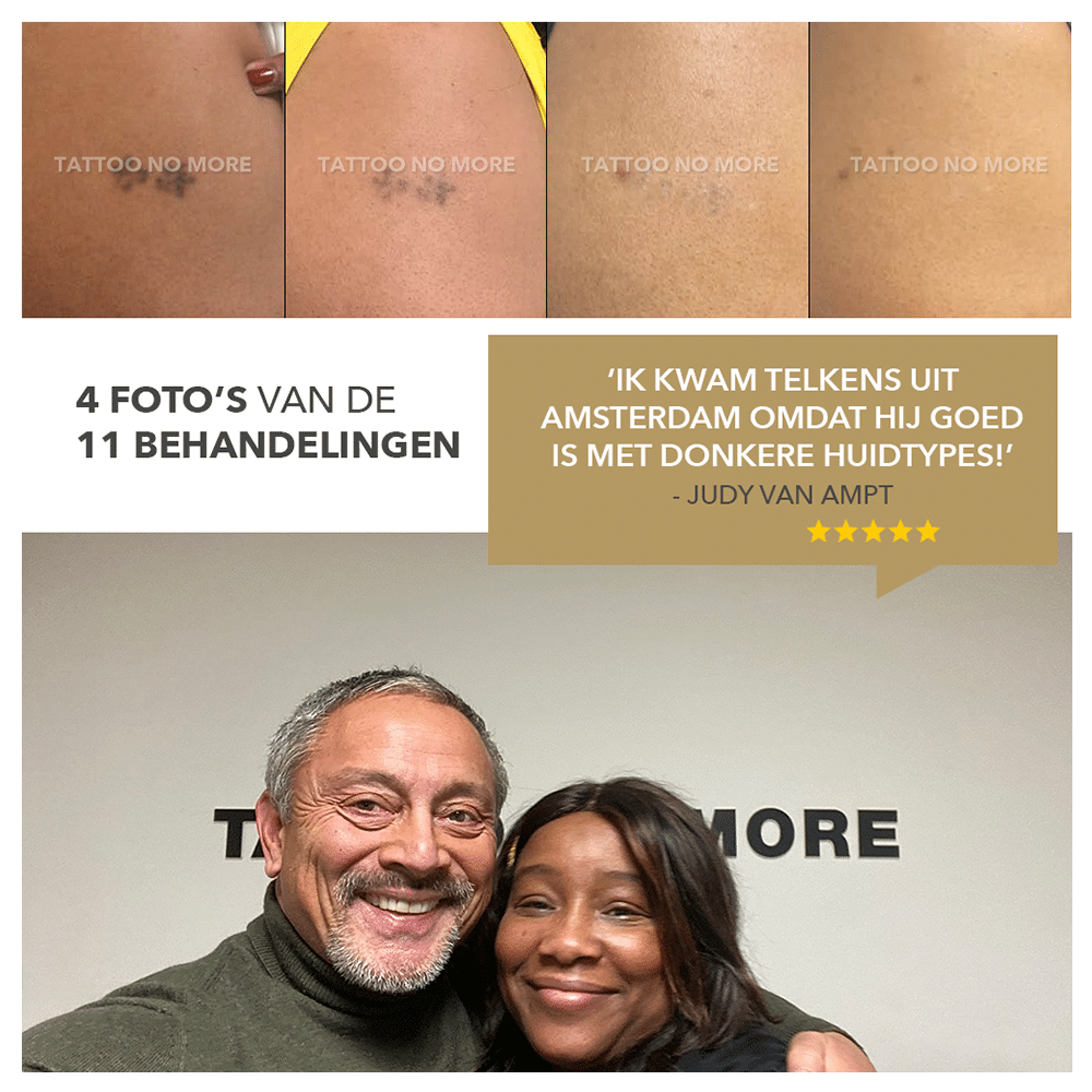 Tattoo verwijderen op een donkere huid