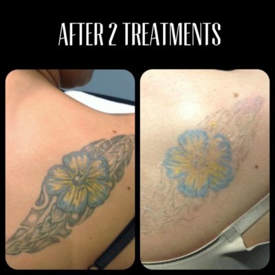 Tattoo Removal Portland | Cascade Tattoo Removal 400_x_400_jpg
