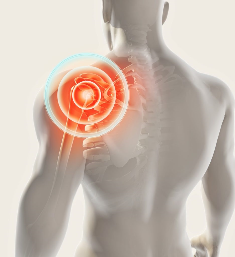 Physiotherapy after Rotator cuff surgery. What to expect? Taunton