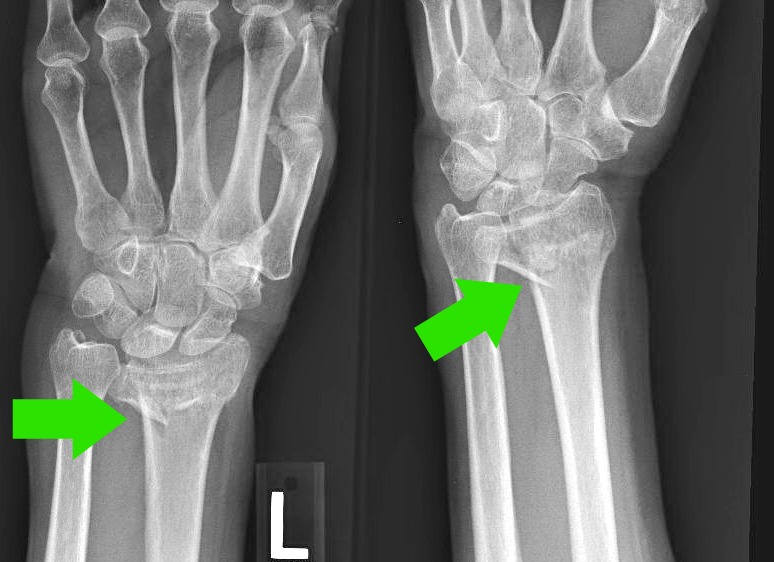 Osteoporosis Case Study 2 Radius Wrist Fracture