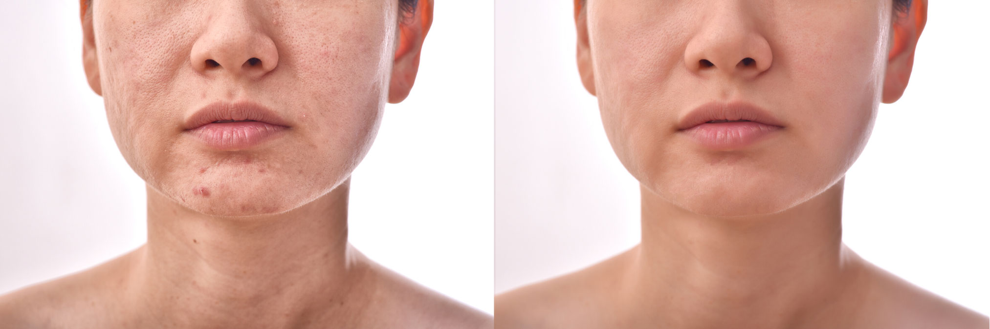 How to repair a damaged skin barrier? TCT Nutraceuticals