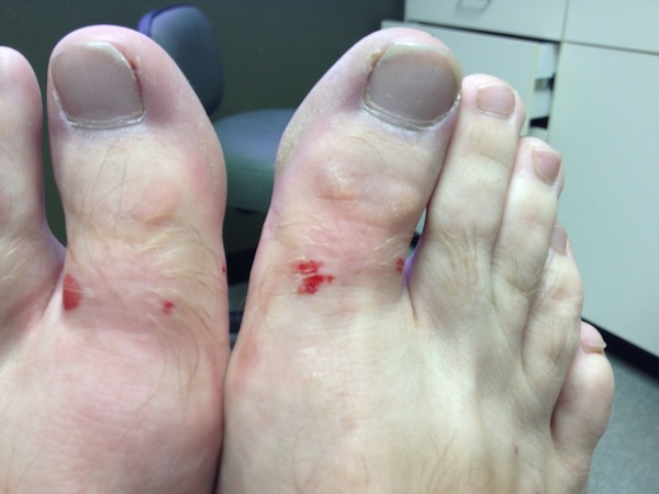 Ingrown Toenail Surgery Post Op Care Tdhurst W Pictures