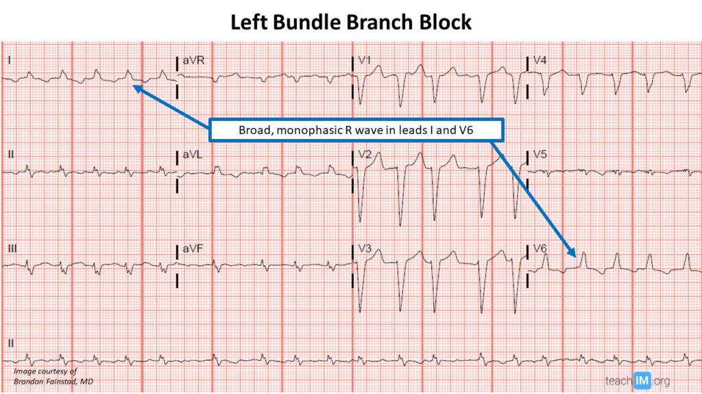 Bundle Branch Block Archives teachIM