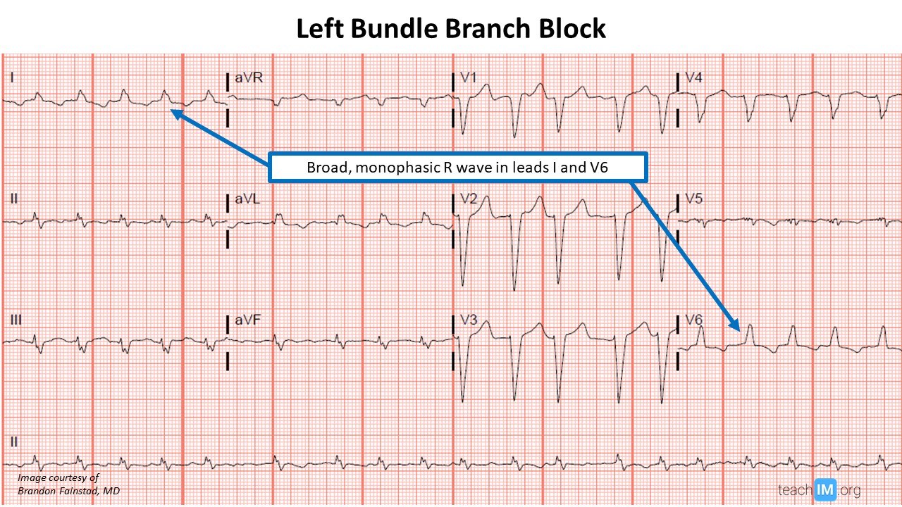 Left Bundle Branch Block (LBBB) ECG teachIM