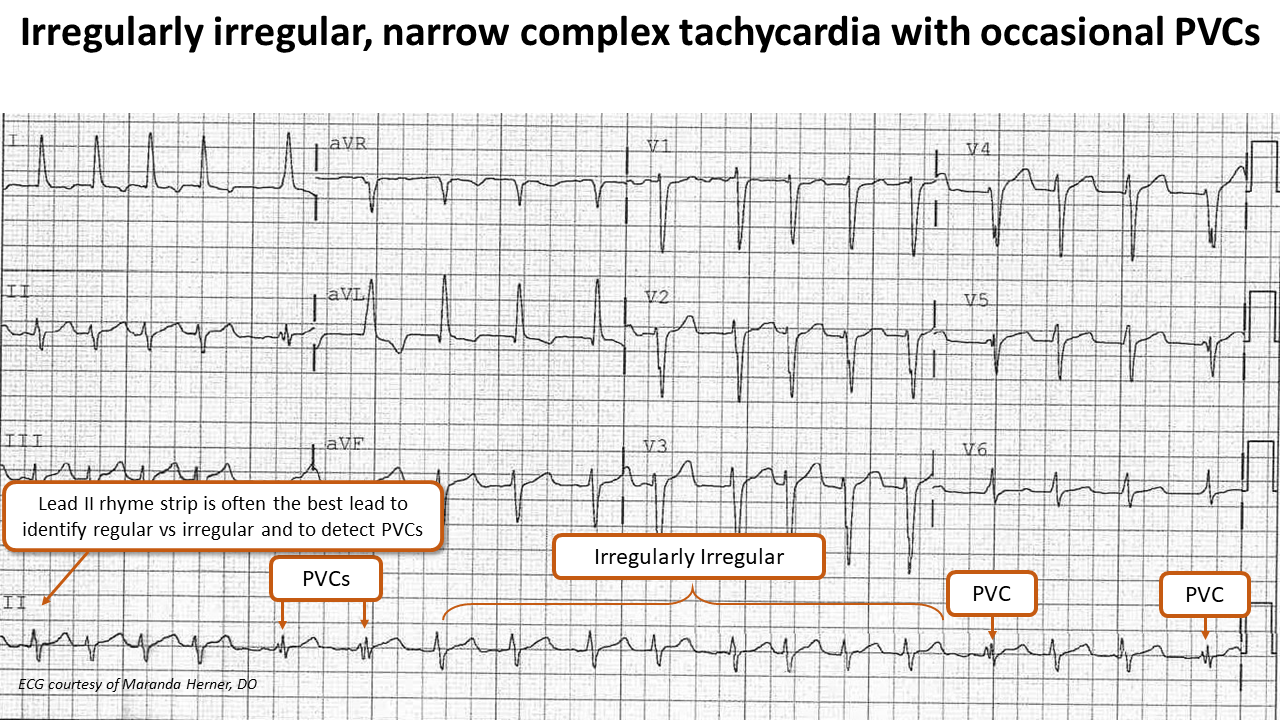 Atrial Fibrillation ECG teachIM