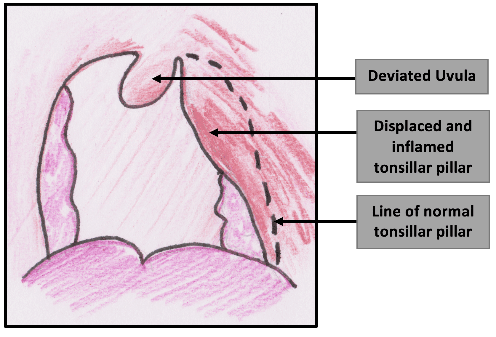 Peritonsillar abscess Management TeachMePaediatrics