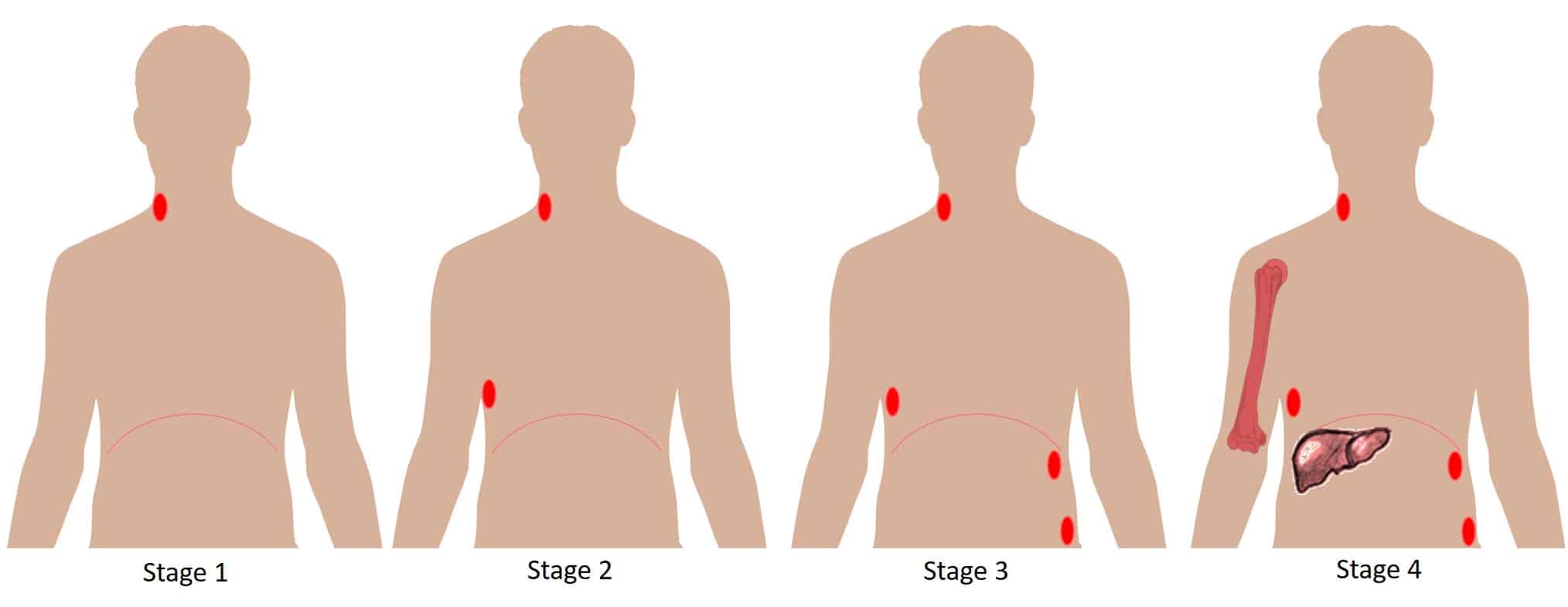 Lymphoma Pathophysiology Management TeachMePaediatrics