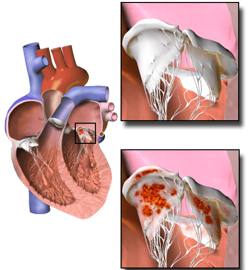 Infective Endocarditis Management TeachMePaediatrics