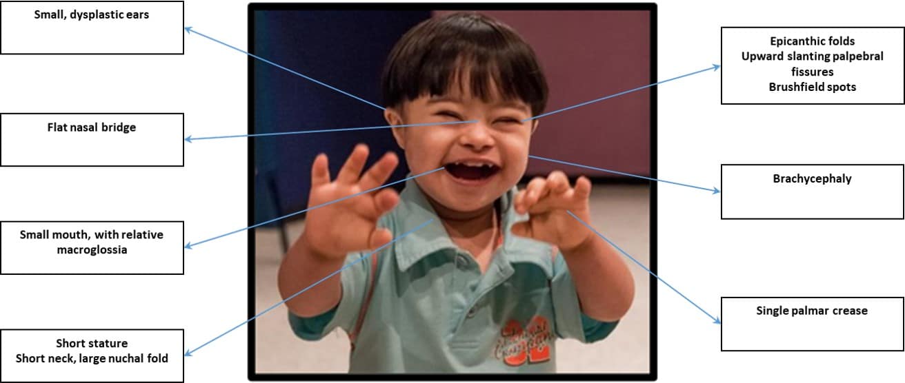 Down Syndrome TeachMePaediatrics