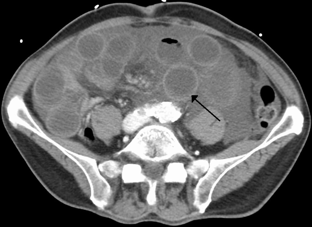 Acute Mesenteric Ischaemia Causes Management TeachMeSurgery