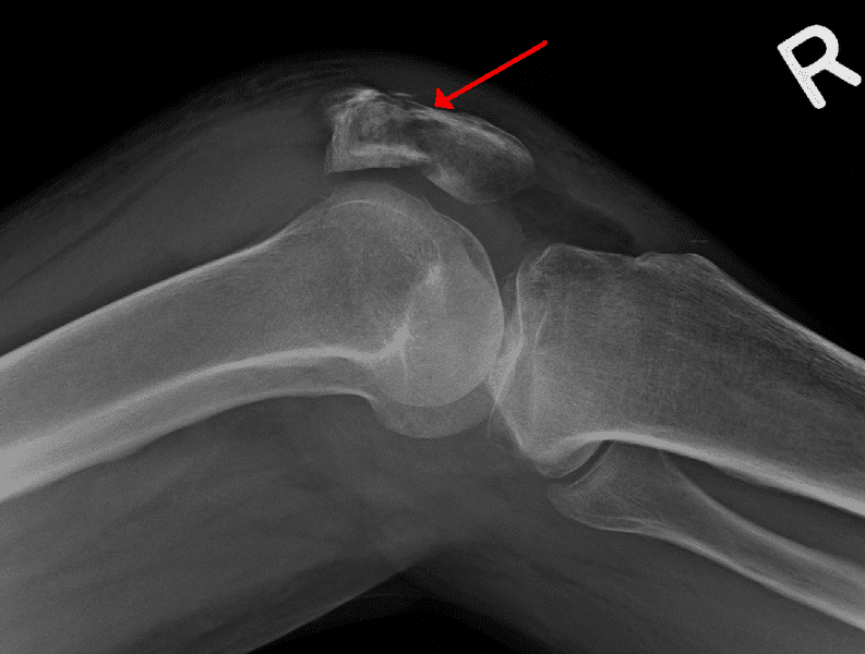 Patella Fracture TeachMeSurgery
