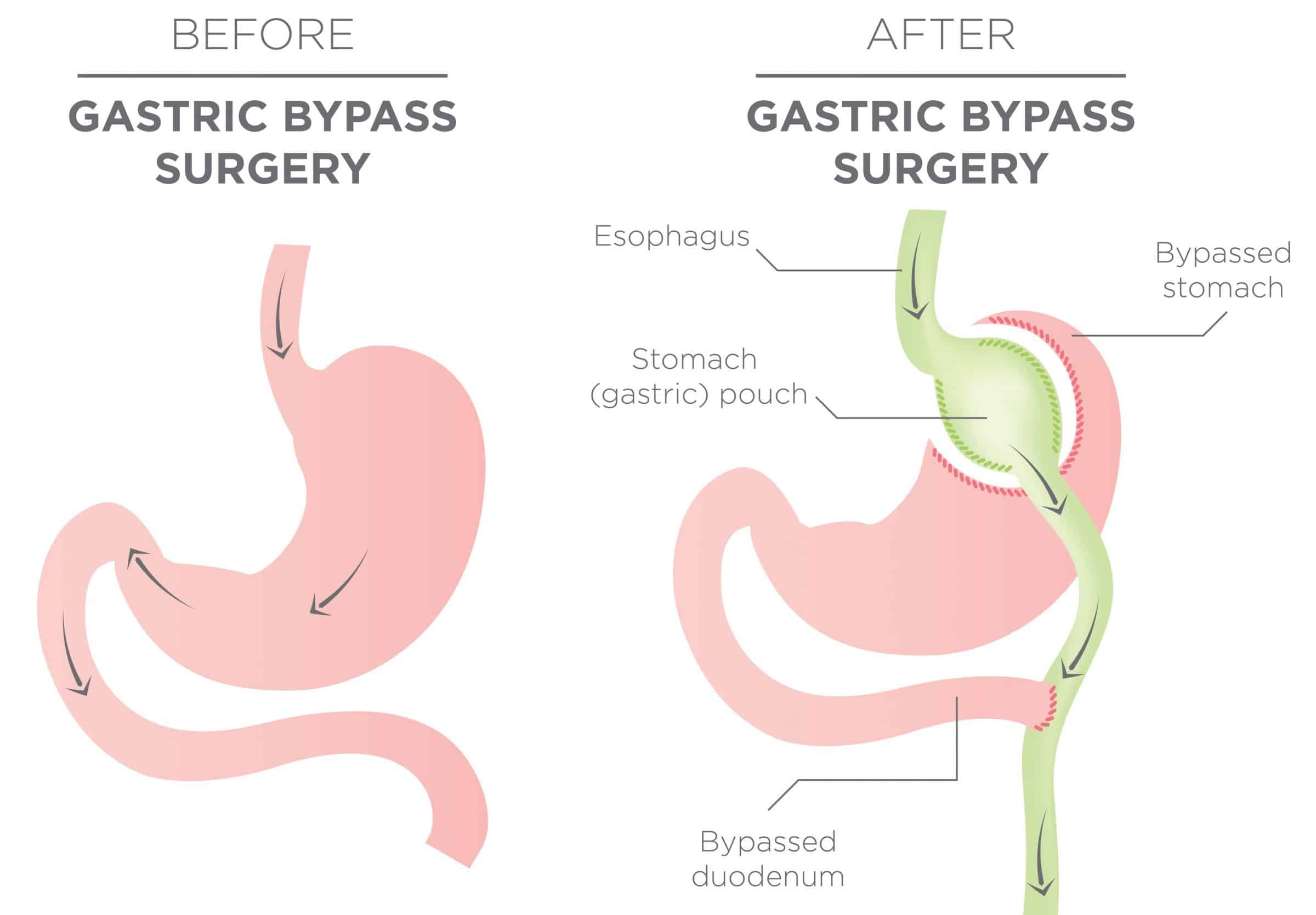 Consent: Gastric Bypass - TeachMeSurgery