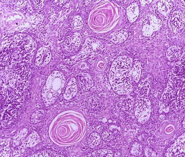 Squamous Cell Carcinoma Histology